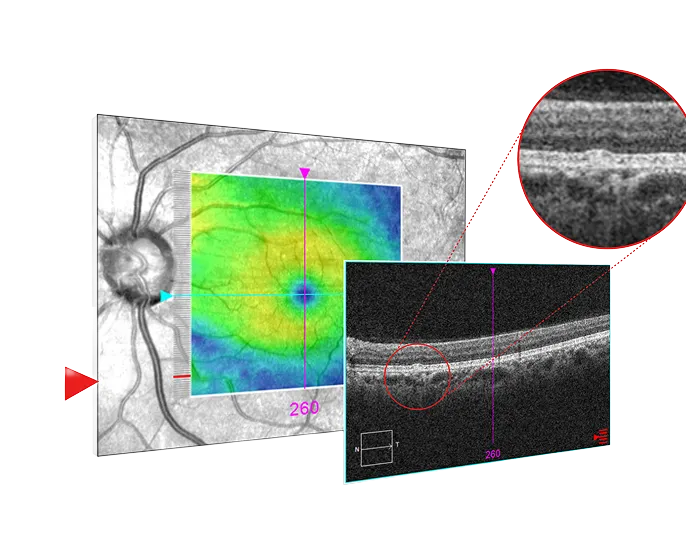 Zeiss CIRRUS PathFinder